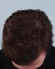 After Hair Transplant&nbsp;Front